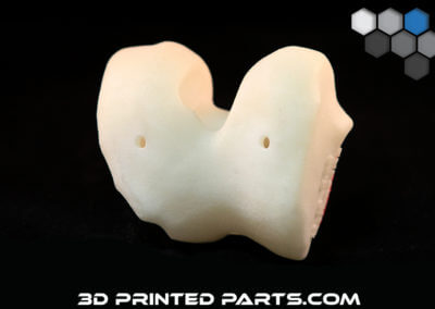 3D Printed Knee Replacement