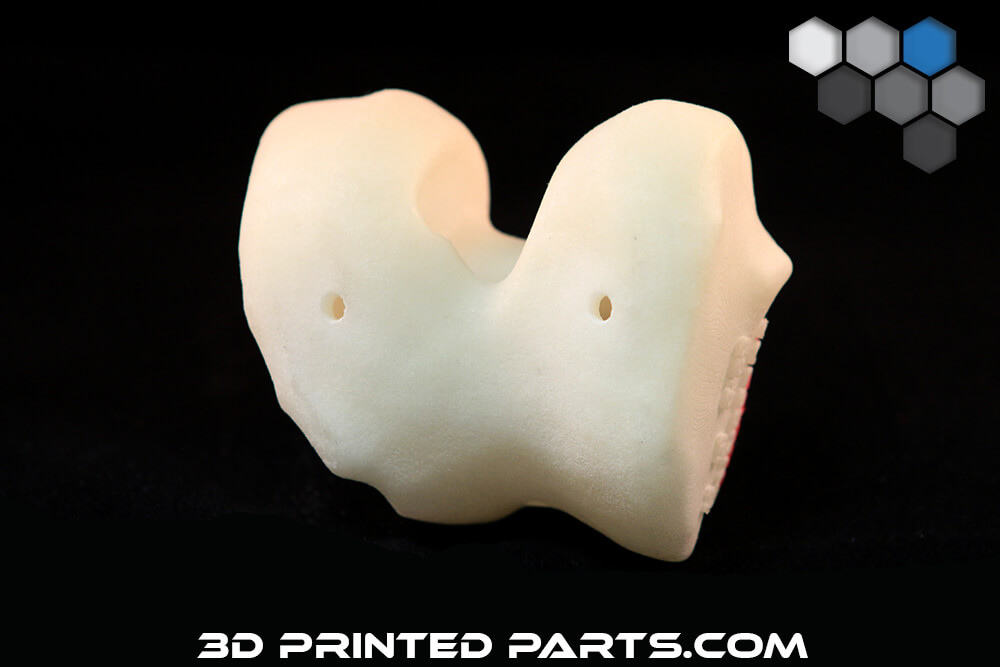 3D Printed Knee Replacement